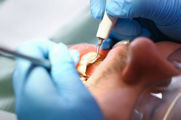 Best Emergency Wisdom Teeth Removal in Ahwahnee, CA