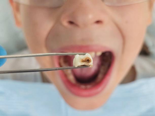 Best Emergency Dental Care for Broken or Chipped Teeth in Ahwahnee, CA
